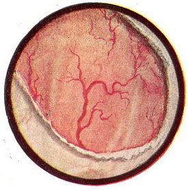 лейкоплакия мочевого пузыря